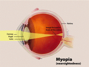 myopia eye